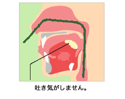 鼻からの胃内視鏡